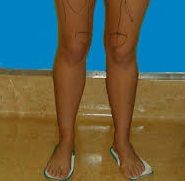 liposucción rodillas