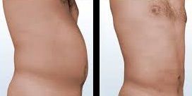 antes y después liposucción