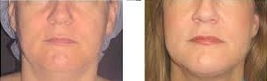 liposucción facial