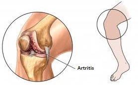artritis y artrosis