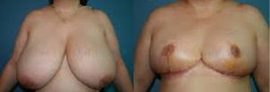 reducción de pecho con la mamoplastia